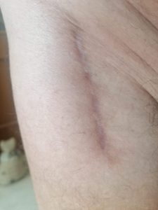 Protesi dell’anca con accesso mini invasivo anteriore cicatrice
Mk Medical Poliambulatorio Roma