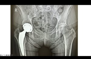 Protesi dell’anca con accesso mini invasivo anteriore immagine radiografica
Mk Medical Poliambulatorio Roma