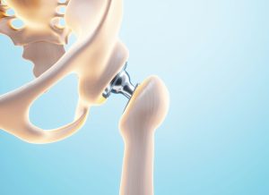 Protesi dell’anca con accesso mini invasivo anteriore
Mk Medical Poliambulatorio Roma